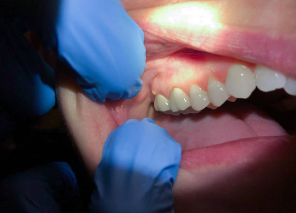 Best Emergency Dental Care for Abscessed Tooth in Arlington, GA