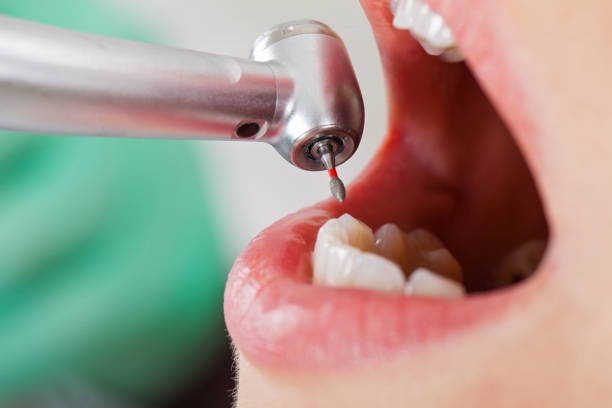 Best Emergency Dentist for Lost Fillings or Crowns in Arlington, GA
